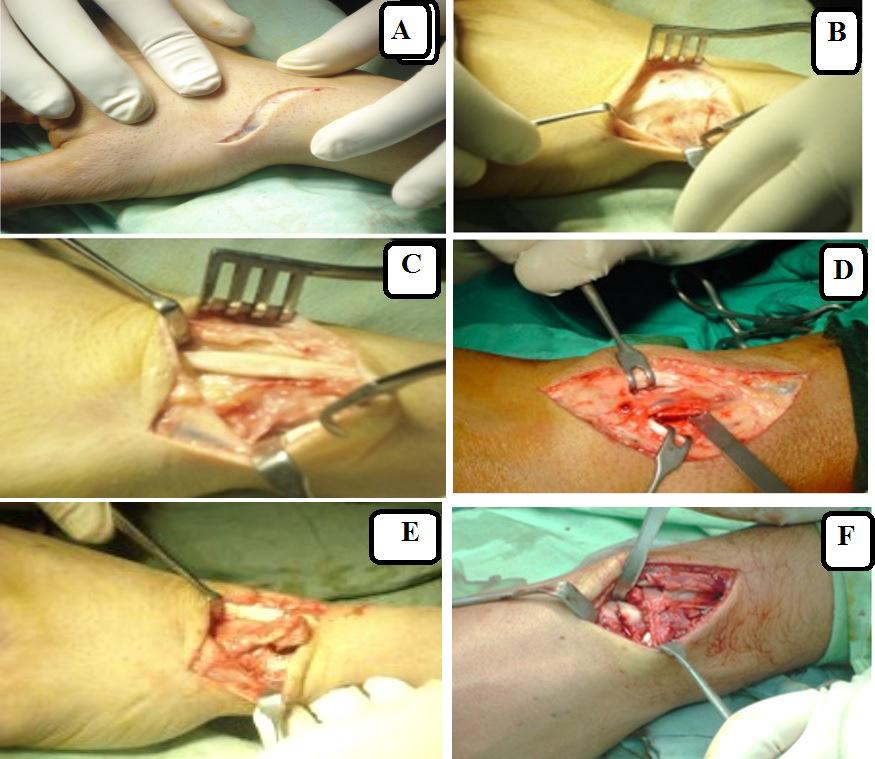 size. A dorsal distal radius wedge graft (with the distal surface wider than the proximal) was obtained with careful protection of the vascular pedicle containing the 1.