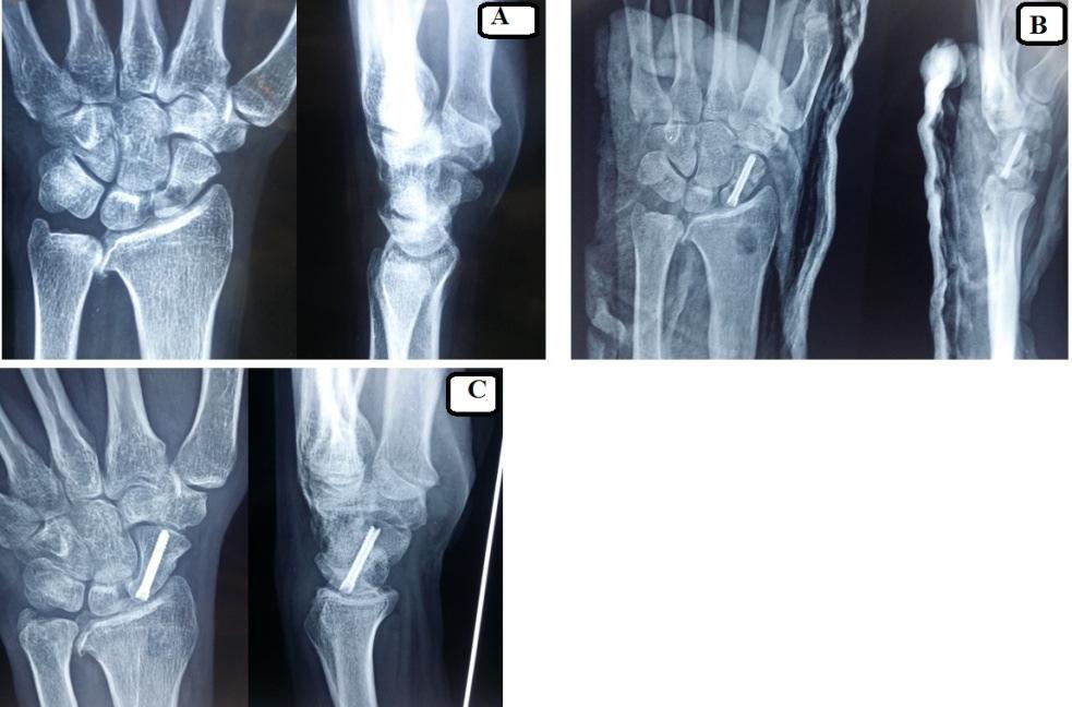 Postoperative follow-up A compressive dressing with a bivalved short-arm scaphoid cast was applied and maintained till suture removal 2 weeks postoperatively.