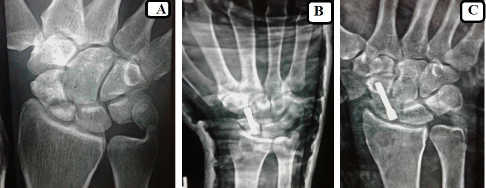 Figure 3: A: preoperative radiograph showing proximal pole scaphoid ununited fracture, B: postoperative radiograph, C: radiograph after union.