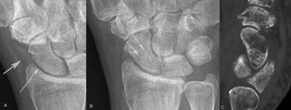 Bone Scan - Less often utilized MRI - Do not use to