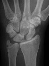 Most Common major ligamentous injury of the wrist FOOSH May be