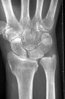 DYNAMIC instability EARLY REFERRAL for operative repair TFCC Injury (Triangular Fibrocartilage Complex) Stabilizes DRUJ and ulnar