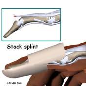 Treatment Splint DIP in extension 6 weeks