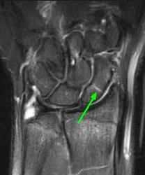 21 MRI most sensitive method to diagnose of occult fractures within 24 hours