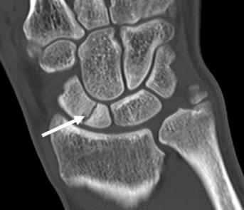 23 CT less effective than bone scan and MRI to diagnose occult fracture can be used to evaluate