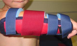 Splinting: 4 weeks Post-Op Splint: fabricated in position of pronation with the wrist in neutral or slight extension determined by the position of casting 28 Treatment Goals: 4 weeks Post-Op 1.