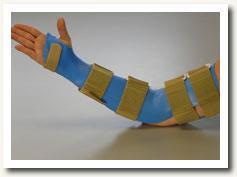 Long Arm elbow extension splint: wrist neutral,