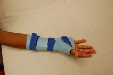 Splinting 4 weeks post-op Fabricate volar forearm thumb spica splint with wrist in 15 degrees extension and thumb in radial abduction Worn full time for a minimum of 2 weeks depending on tone 79