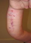 Measure: length, width Note open areas 23 Evaluation: Clinical Observations Edema: