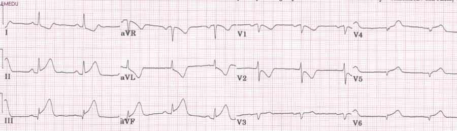 Sinus rhythm ST depression Lead I, avl, ST elevation V5, V6 Lateral MI (acute over chronic) ST elevation in III and avf