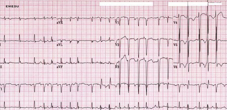 rate, rhythm and axis for these patients, and is there any other abnormalities?