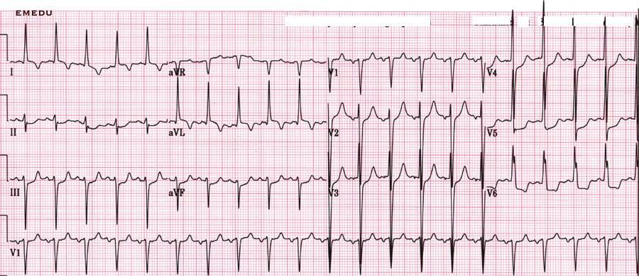 , LVH due to deep S and huge R, T inversion can be seen laterally.