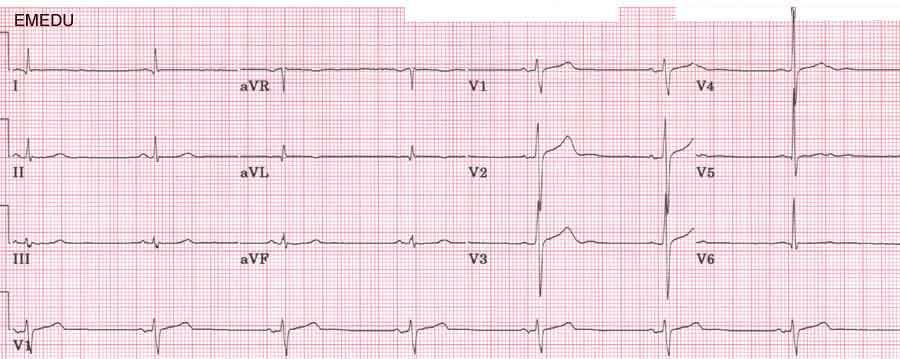 in lead avr Bradycardia, and obvious delta wave in V1 WPW