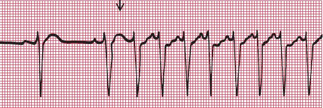 QT interval must be corrected because it s affected by the HR: QT interval Abnormalities Long QT (>450ms) can be genetic (long QT syndrome) or secondary due to drugs (amiodarone, sotalol) Associated