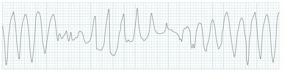 Torsade de Pointe: usually with prolonged QT interval The QRS complexes spin around the baseline, changing their axis