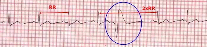 extrasystole/ectopic beat : QRS would look broad and bizarre, not preceeded by P and followed by opposing ST-T