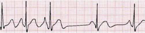 In Atrial extrasystole/ectopic beat: QRS would look normal, abnormally looking P wave and with a compnesatory pause.