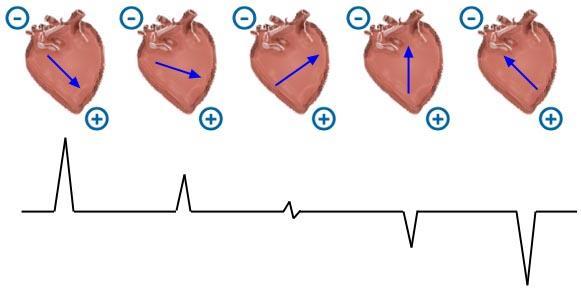 electrode. The 12-Lead ECG 6 limb leads: I between right arm and left arm.