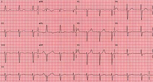 ECG Record with some abnormalities: 12 leads with a rhythm strip (II) Good Voltage (2 Lsq or 1cm vertical) HR > 60