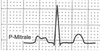 .. P Mitral: Bifid in Lead II Left Atrial dilatation/hypertrophy due to Mitral stenosis (MS) or sometimes MR Too short (<3 Ssq) Too long (>1Lsq) PR Interval Abnormalities - Wolf Parkinson White