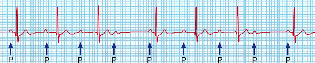 In fact, the PR interval isn t shortened, but it looks so due to the emergence of the delta wave.