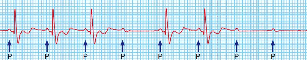 are conducted 2 nd degree Heart block (Mobitz 1)/Wenckebach: - Progressive prolongation of the PR interval until a P