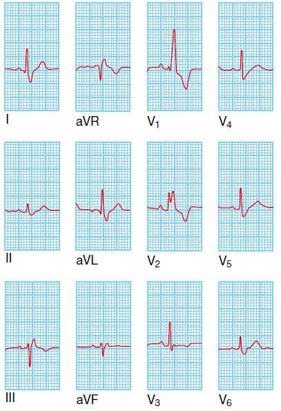 Spot on LBBB and RBBB: Common causes ECG changes Appearance RBBB - Normal variant - Right