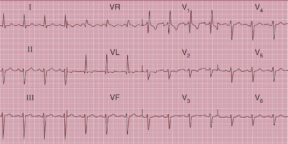 LBBB - CAD - HTN - Aortic valve disease - Cardiomyopathy QRS > 3 Ssq RSR (M shaped QRS