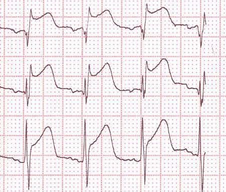ECG Changes; Myocardial Ischemia That May Progress to MI Patients with ST segment elevation: