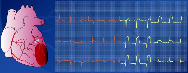 Anterior infarction I II III avr avl avf V1 V2