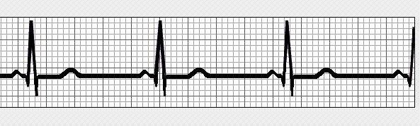 Cardiac Rhythm Is the rhythm regular or not?