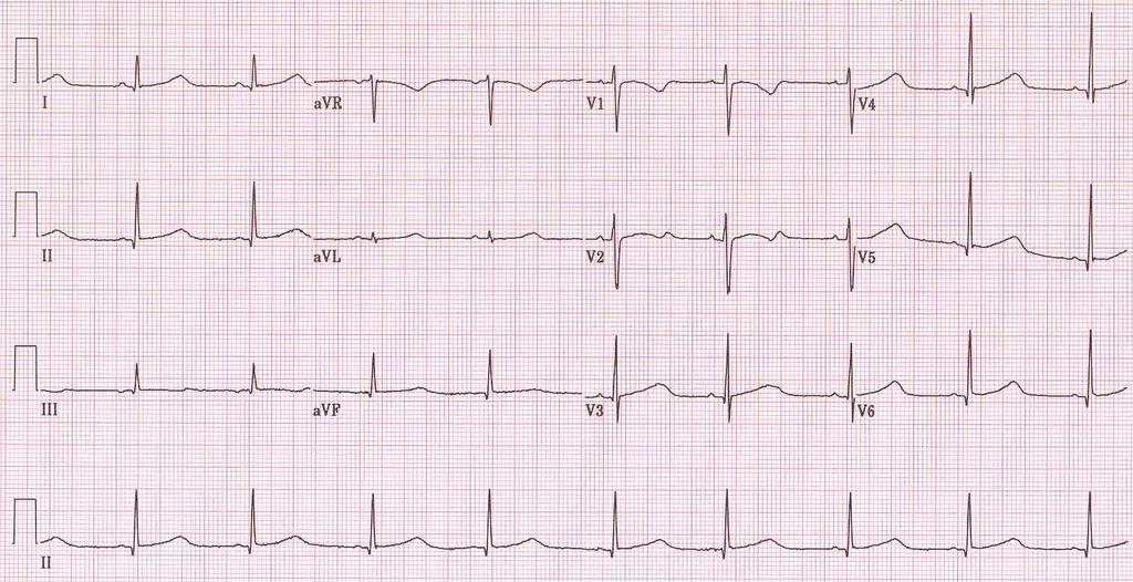 6 Limb Leads 6 Chest Leads (Precordial leads) avr,