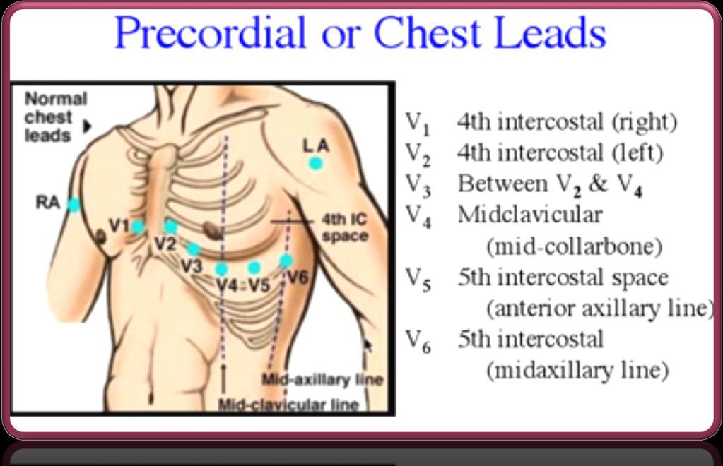 6 Unipolar leads Also known as precordial
