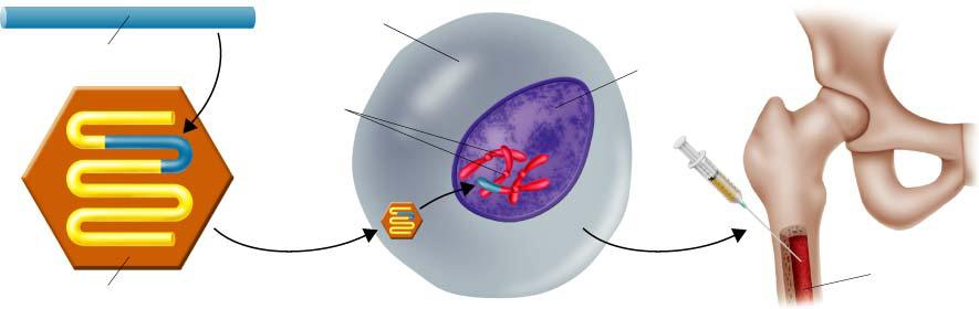 Gene Therapy - Normal hemoglobin gene Bone marrow
