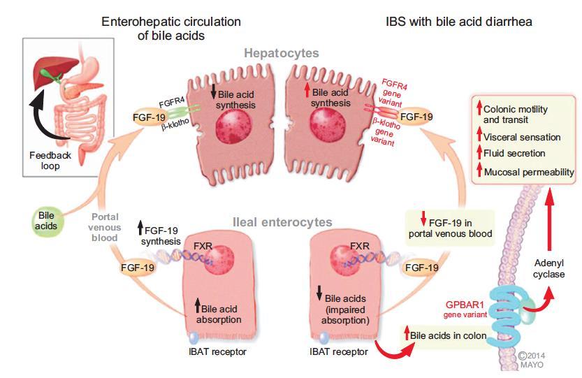 Bile Acid Sequestrants Bile acid malabsorption: prevalence estimates 1%; 25-50% in IBS-D 3 established types of BAM (maybe 4) Excess bile acids in colon Stimulate enteroendocrine cells and accelerate