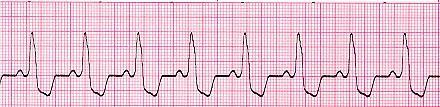 conduction through the bundle branches will cause a depolarization delay through the ventricular muscle, this delay shows as a widening of the QRS complex.