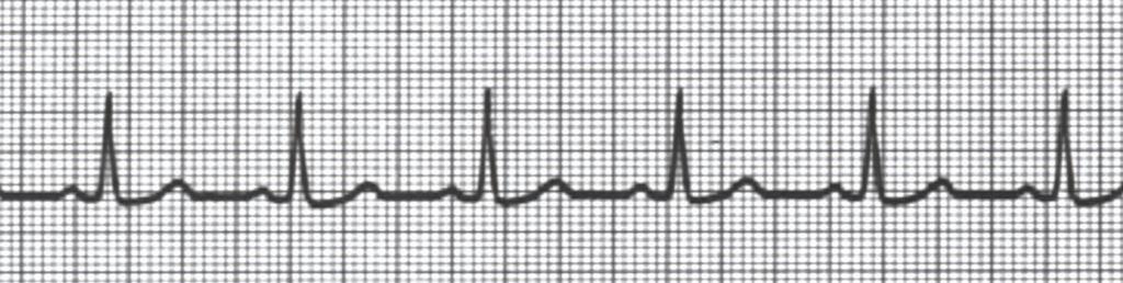Systematic ECG analysis The first step in ECG interpretation is recognising sinus rhythm, the normal cardiac rhythm. This allows for the identification of abnormalities and arrhythmias. 1.