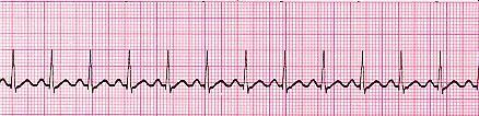 examples Sinus Tachycardia Rate - More than 100 beats per minute P Wave - Visible before each QRS complex P-R Interval - Normal The impulse generating the heart beats are normal, but they are