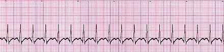 Supraventricular Tachycardia (SVT) Abnormal Rate - 140-220 beats per minute QRS Duration - Usually normal P Wave - Often buried in preceding T wave P-R Interval - Depends on site of supraventricular