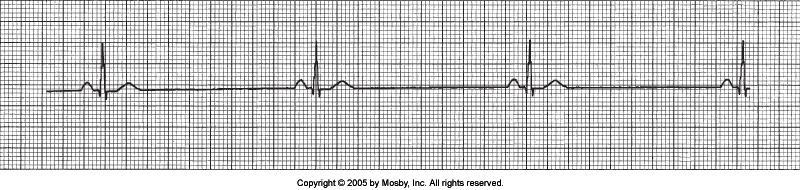 Sinus Bradycardia Why Sinus Bradycardia? Regular Rate < 60 1 P for every QRS PRI between.12 &.20 seconds QRS width = 0.