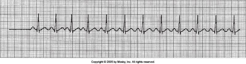 Sinus Tachycardia Why? HR between 100 & 150 Rhythm and intervals OK Common Causes?