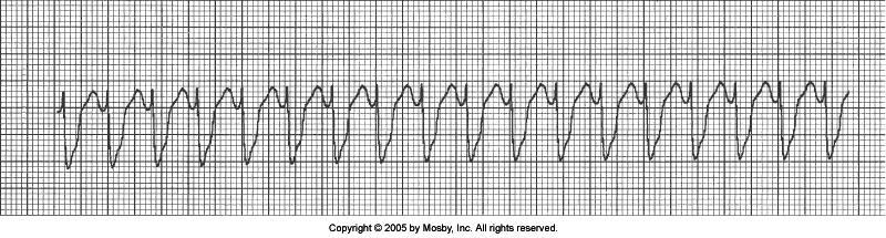 Ventricular Tachycardia Why? Rate generally between 100 & 200 P-waves not present PRI not measurable QRS wide and bizarre, width > 0.