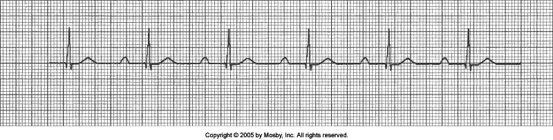 First Degree Heart Block Why? Regular rhythm Rate 60-100 QRS < 0.12 secs PRI Interval > 0.20 secs Causes?