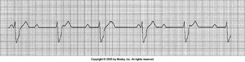 Third Degree Heart Block Why? Independent atrial (P wave) and ventricular activity.