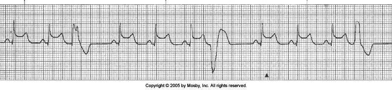 ST Elevation with a PVC Cause: Acute MI Treatment: