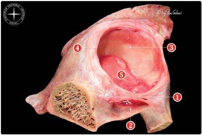 Figure 5: Posterior inferior view of an osteoarticular dissection of the acetabular area.