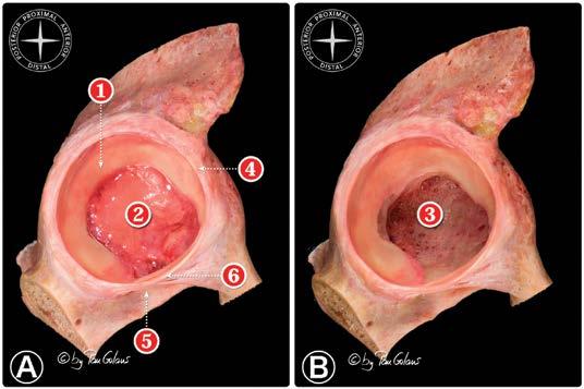 teres has been resected) (Figure copyright Pau Golanó 2014). Figure 6: Anterior view of an osteoarticular dissection of the acetabular area.