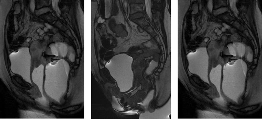 Gynecol Surg (2014) 11:249 256 251 respectively. Images were obtained in sagittal, axial, and coronal orientation using body coil at rest, squeeze, and push with maximal strain [Fig. 1].