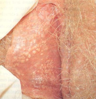 Normal Fordyce spots Sebaceous glands