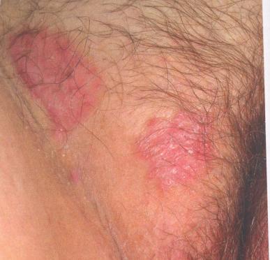 Psoriasis Obstetric and